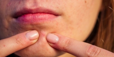 Çenede Sivilce: Nedenleri ve Çözüm Yolları